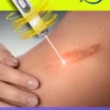 Laser therapy Keloid scar